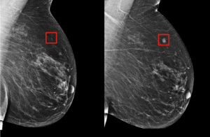BreastCancerAI